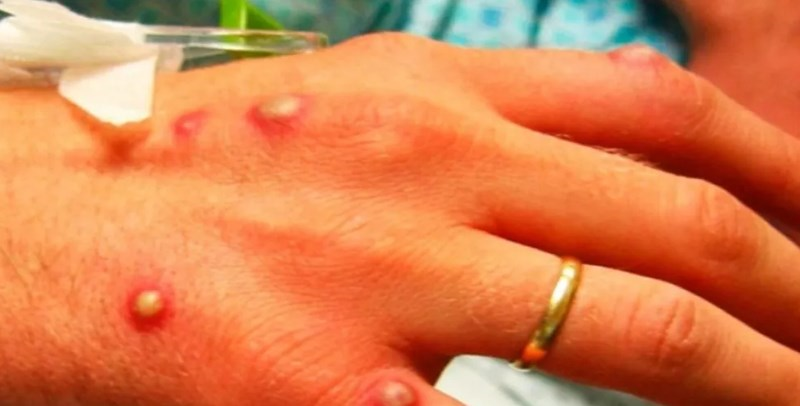 Monkeypox Confirmed first 77 cases detected in Ontario, Quebec, Alberta, British Columbia, Canada