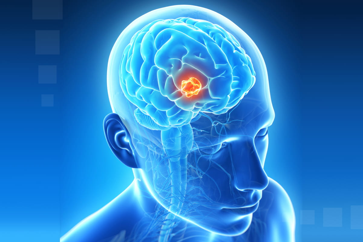 Baló’s Disease