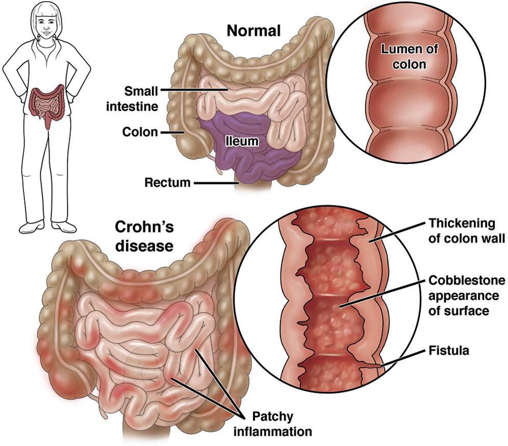 Crohn’s Disease
